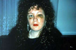 Nan Goldin, Nan one month after being Battered 1984