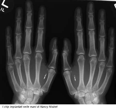 I chip impiantati nelle mani di Nancy Nisbet